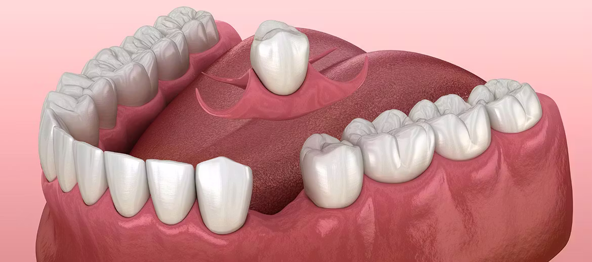 Denture